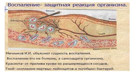 Воспаление: защитная реакция организма