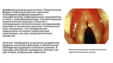 Воспаление гортани