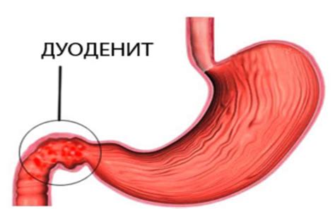 Воспаление желудочно-кишечного тракта