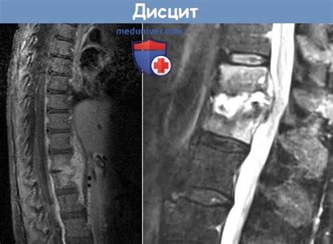 Воспаление межпозвоночного хряща