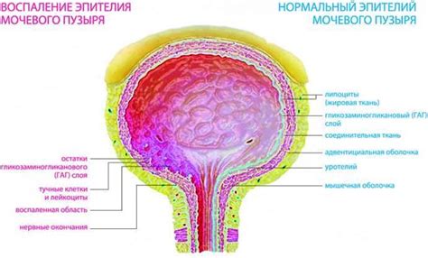 Воспаление мочевого пузыря