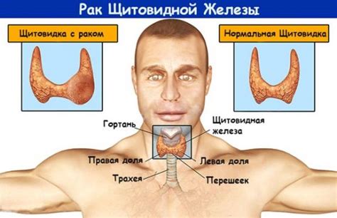 Воспаление щитовидной железы