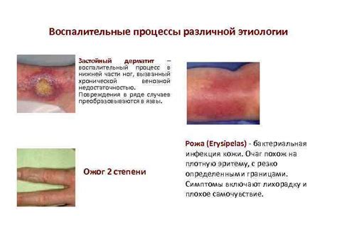 Воспалительные процессы в тканях ног при повышении температуры