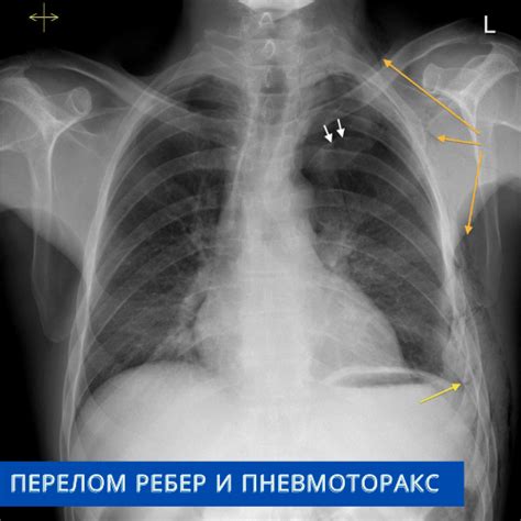 Восстановление сломанного ребра с помощью магнитотерапии