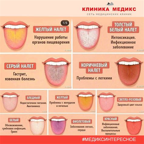 Вредность и последствия серого налета на языке