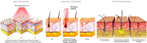 Вредные эффекты лазерной эпиляции