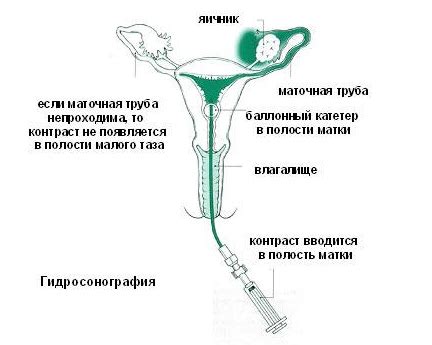 Второй метод лечения заполнения маточных труб