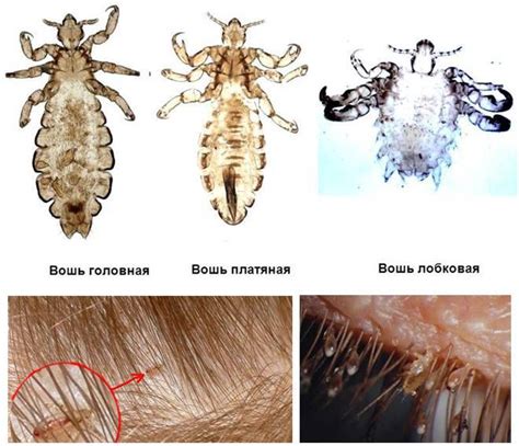 Вши и гниды: причины и методы борьбы