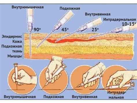 Выбор места для инъекции на бедре