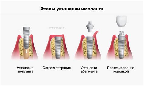 Выбор способа установки и фиксация окрины