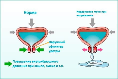 Выделение мочи при половом акте: основные причины и методы предотвращения