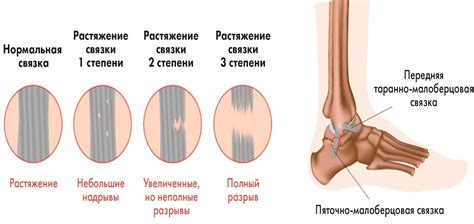 Вызванные травмами растяжения связок