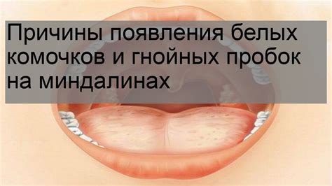 В чем причины появления белых точек на миндалинах?