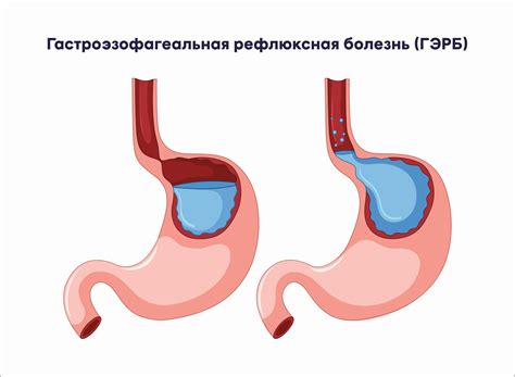 Гастроэзофагеальная рефлюксная болезнь (ГЭРБ): как ее облегчить?