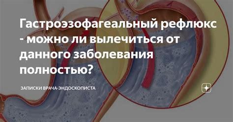 Гастроэзофагеальный рефлюкс: причина появления отрыжки и сопутствующего кома в горле