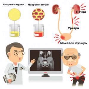 Гематурия у мужчин: причины и симптомы