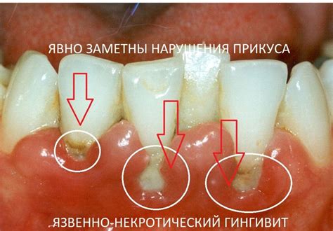 Гингивит и его симптомы