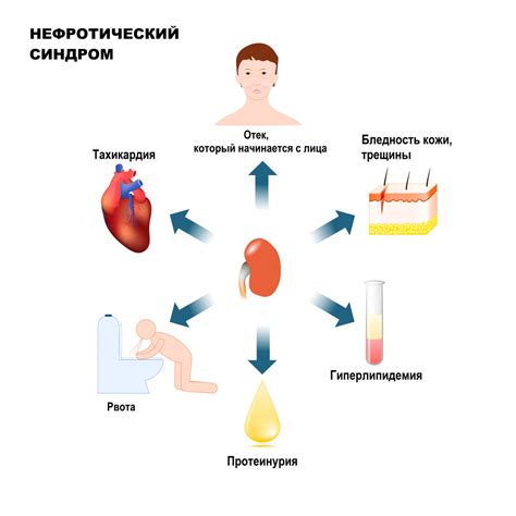 Гиперлипидемия при нефротическом синдроме: причины образования