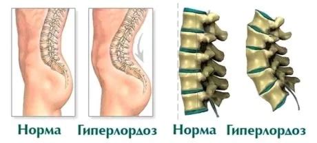 Гиперлордоз спины: причины и симптомы