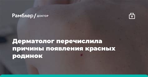 Главные причины появления родинок