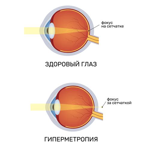 Глазные заболевания и нарушения