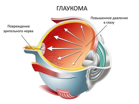 Глаукома и ее последствия