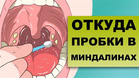 Гнойники на миндалинах: самостоятельное удаление возможно?