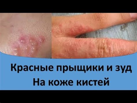 Гормональное дисбаланс и красные прыщики