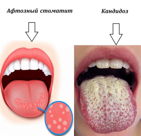 Грибковая инфекция языка