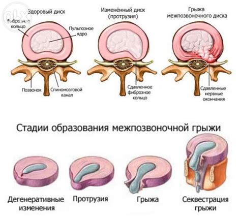 Грыжа межпозвонкового диска