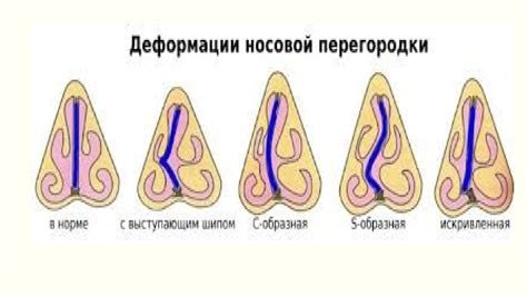 Девиация носовой перегородки