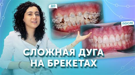 Декоративные элементы на брекетах