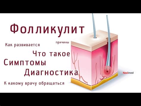 Дефиниция и симптомы аутоиммунного фолликулита