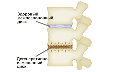 Деформация дисков