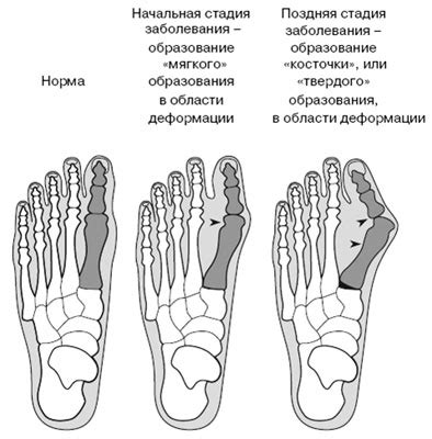 Деформация пальца (халлюкс вальгус)