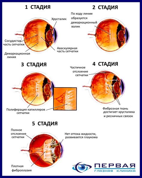 Диабетическая ретинопатия