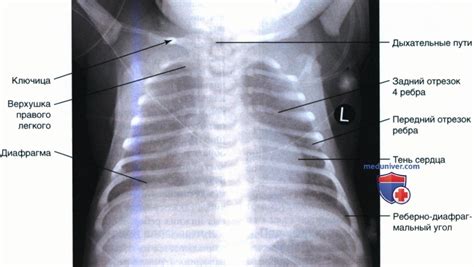 Диагностика впалой грудной клетки у новорожденных