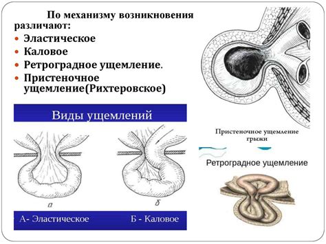 Диагностика защемления пупочной грыжи у взрослых