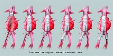 Диагностика и лечение аневризмы брюшной аорты