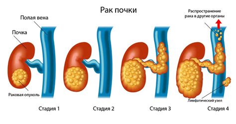 Диагностика и лечение породинок почек