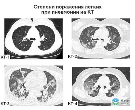 Диагностика легочных опухолей