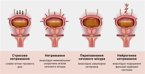 Диагностика нарушения мочеиспускания