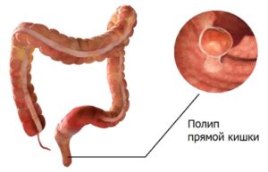 Диагностика полипов в прямой кишке