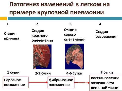 Диагностирование пневмонии и необходимые меры лечения