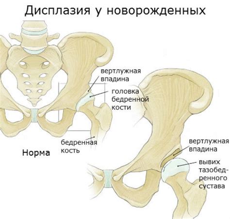 Дисплазия тазобедренного сустава