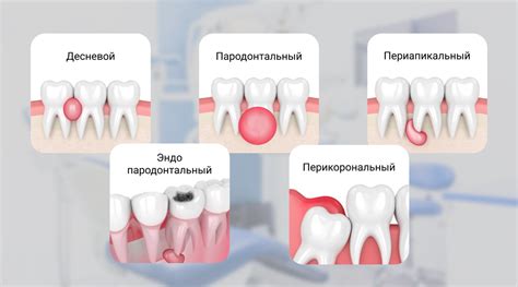 Домашние методы удаления абсцесса на десне