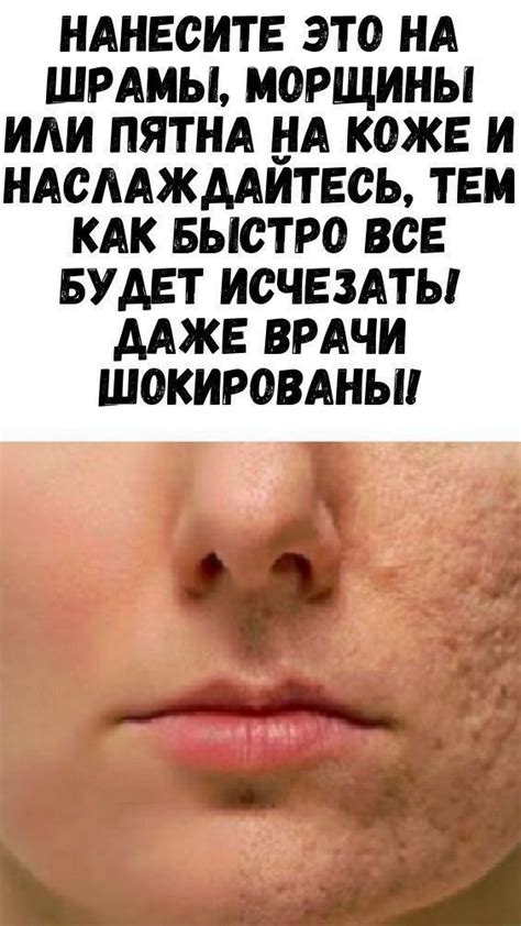 Домашние методы устранения рубцов