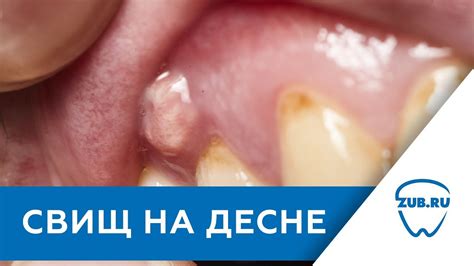 Естественные способы справиться с опухолью на десне и щеке