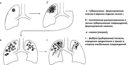 Заболевания, сопутствующие туберкулезу