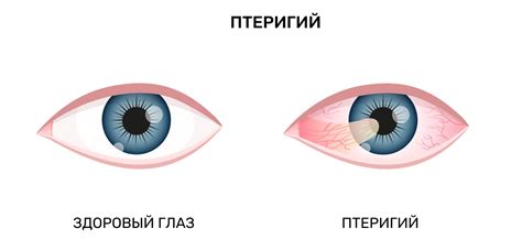 Заболевания глаз, приводящие к болевым ощущениям